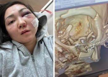 «Бетімдегі бұлшықет шіріп кеткен». Күйеуі өлімші етіп сабап тастаған әйел денсаулығы туралы айтты