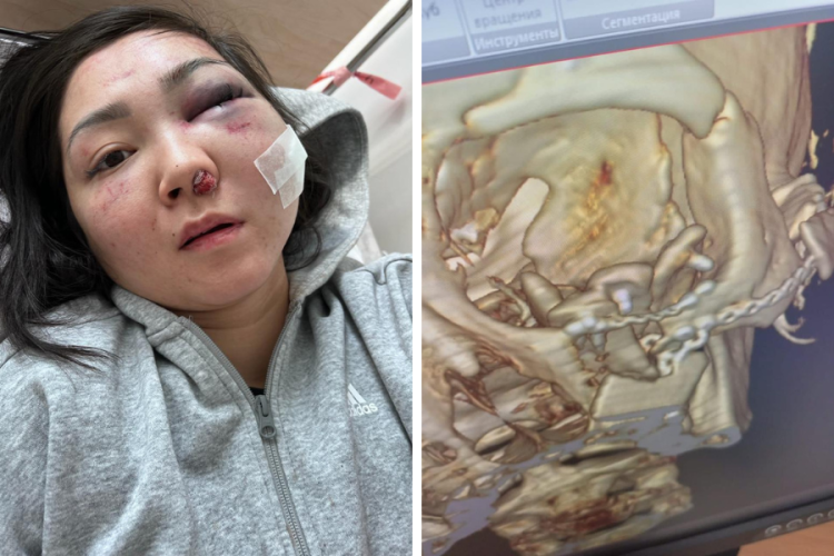 «Бетімдегі бұлшықет шіріп кеткен». Күйеуі өлімші етіп сабап тастаған әйел денсаулығы туралы айтты