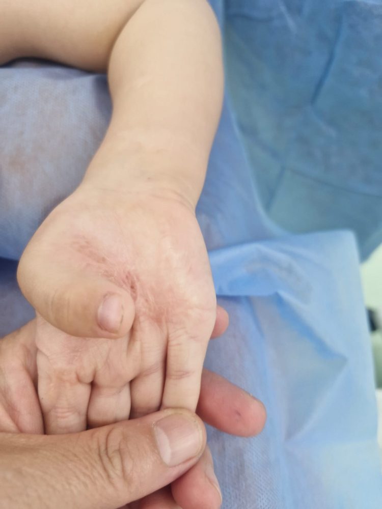 Врачи ОДКБ успешно устранили последствия тяжёлого ожога у ребёнка